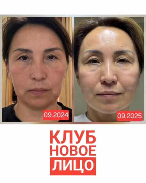 клуб новое лицо естественное омоложение